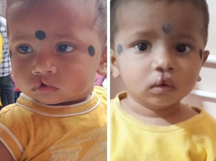 कोंडागांव में गरीब परिवारों को राहत:  राष्ट्रीय बाल स्वास्थ्य कार्यक्रम में 18 बच्चों का मुफ्त इलाज, हृदय रोग और कटे होंठ की सर्जरी - Kondagaon News