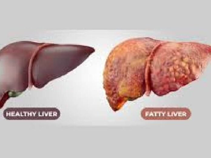 नॉन अल्कोहलिक फैटी लीवर जांचने वाला एमपी पहला राज्य:  90 सेमी से कमर ज्यादा तो आपका लिवर है फैटी, 1 जून से शुरू होगा अभियान - Jabalpur News