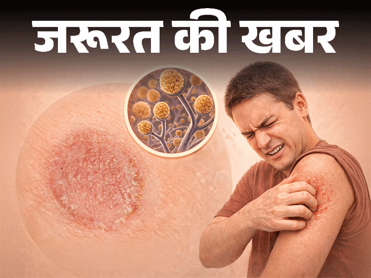 Ringworm Fungal Infection; Skin Infection Causes