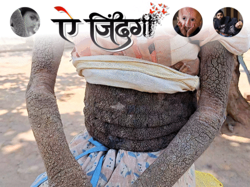 14 की उम्र में शरीर बना 'पेड़ की छाल’:उठो या बैठो फटने लगती है चमड़ी, मन करता है छीलकर फेंक दूं; देश का अकेला केस