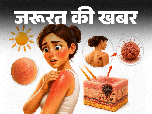 जरूरत की खबर- सनबर्न से बढ़ता स्किन कैंसर का रिस्क:स्किन रखें हेल्दी, ये 7 संकेत इग्नोर न करें, सनबर्न से बचाव के 10 टिप्स