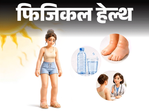 Summer Body Swelling; What Is Heat Edema ? Symptoms, Reason And Treatment